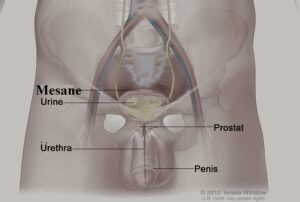 Mesane Kanserinin Güncel Tedavisi (2023)
