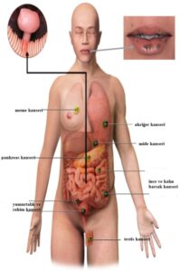 STK11 ve LKB1 Genlerinin Kanser ile olan ilişkisi